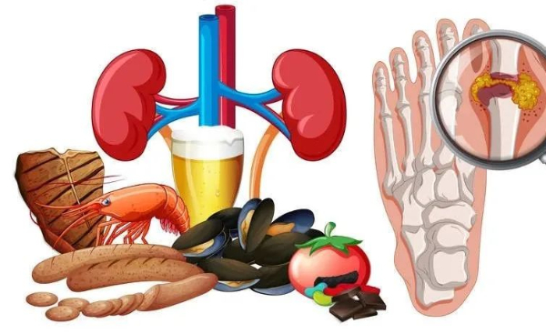尿酸高早晚会得痛风？痛风患者只要