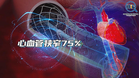 心血管狭窄75%就要放支架吗？